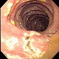 درون‌بین یا آندوسکوپ (به انگلیسی: endoscope)‏