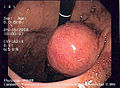 درون‌بین یا آندوسکوپ (به انگلیسی: endoscope)‏