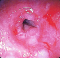 درون‌بین یا آندوسکوپ (به انگلیسی: endoscope)‏